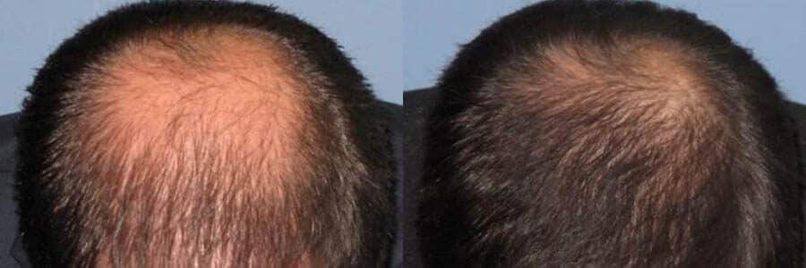 Hair Restoration Center Patient Before and After