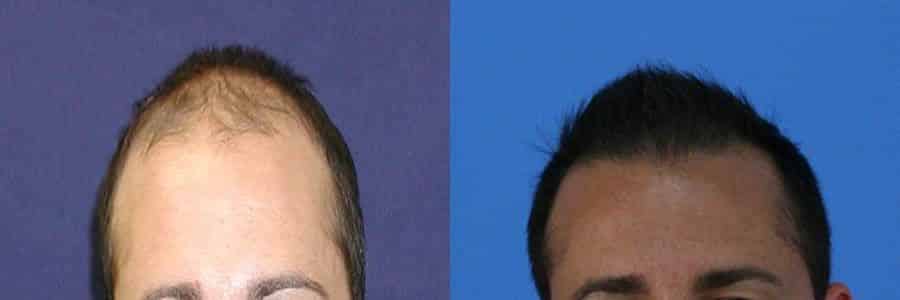 30 Year Old Caucasian Male Brown FUT Hair Transplant Before / After Example