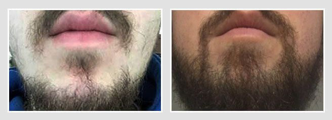 Facial hair transplant before and after for a male beard