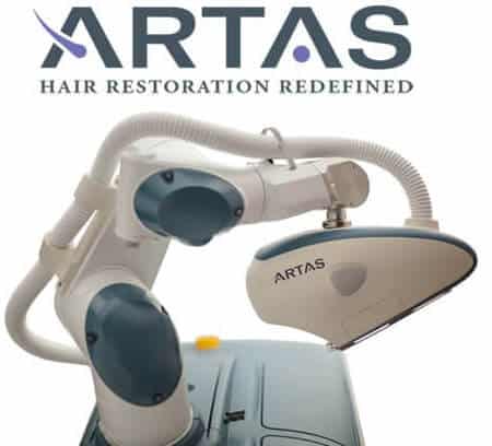 ARTAS Robotic Hair Transplant