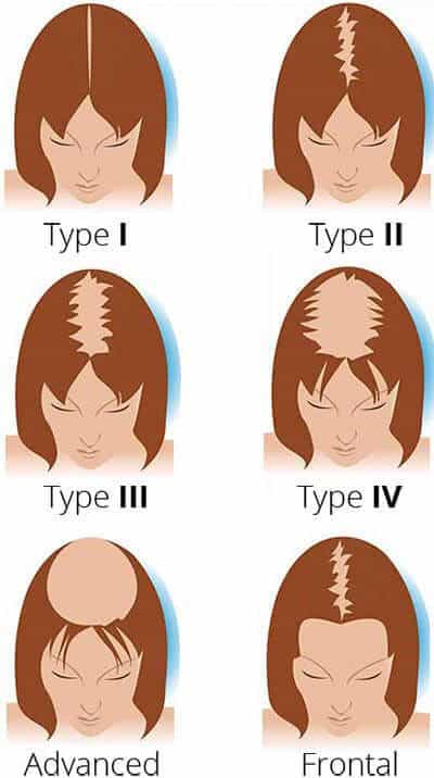 Ludwig Female Hair Loss Chart