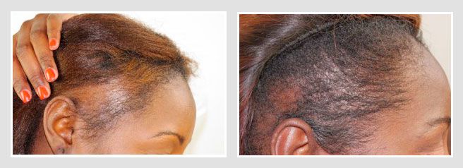 Female African American hair transplant