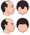 Male Noorwood Classification Male Pattern Alopecia