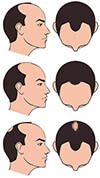 Male Noorwood Classification Male Pattern Alopecia