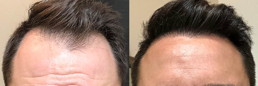 40 Year Old Caucasian Male Brown FUE Hair Transplant Before/After Result