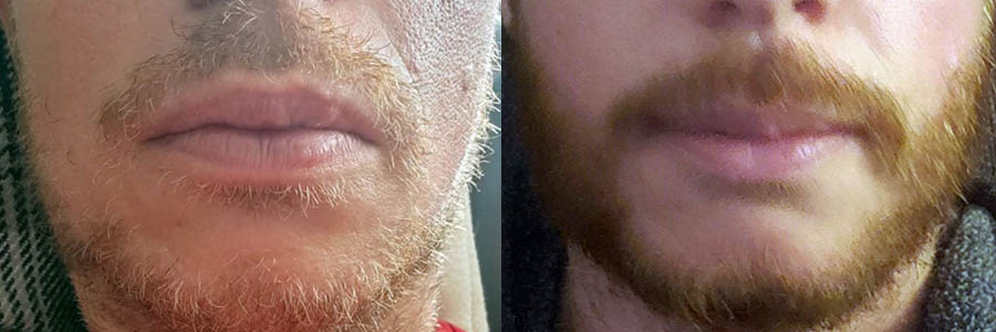 38 Year Old Caucasian Male Red Facial FUE Hair Transplant Before/After Example