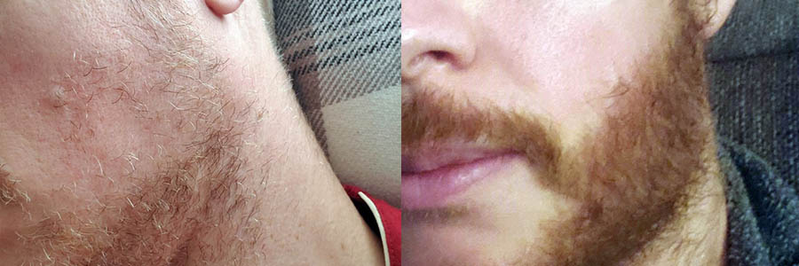 Facial Beard Hair Transplant - Male Before and After