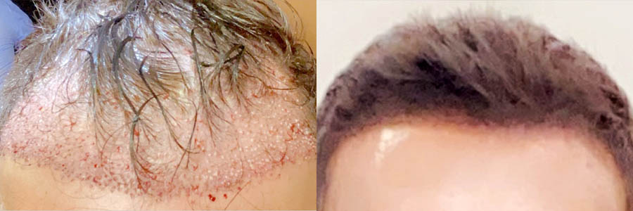 27 Year Old Caucasian Male Brown FUE Hair Transplant Before/After Result