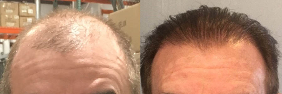 46 Year Old Caucasian Male Brown FUT Hair Transplant Before/After Result