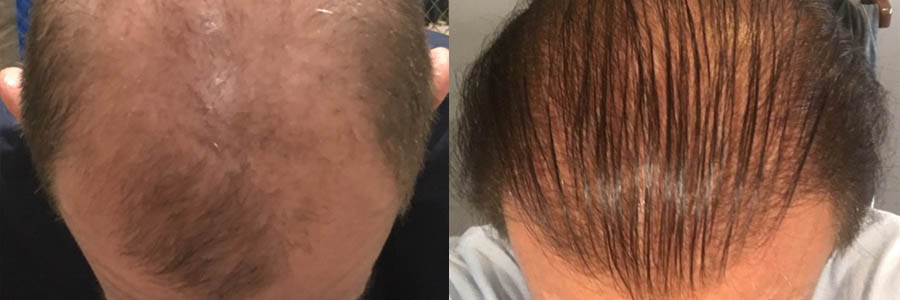 46 Year Old Caucasian Male Brown FUT Hair Transplant Before/After Result -  Hair Restoration Centers