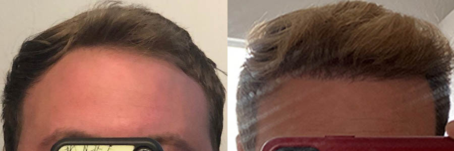 36 Year Old Caucasian Male Blonde FUE Hair Transplant Before/After Example