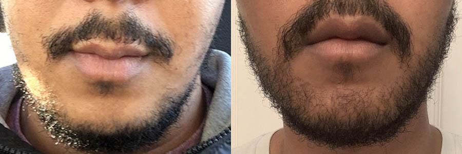 29 Year Old Asian Male Black Facial Hair Transplant Before/After Result