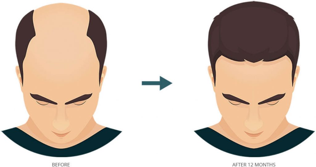 FUT Hair Transplantation Hair Restoration Center