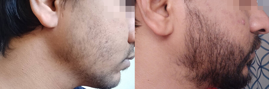27 Year Old Indian Male Black Facial Hair Transplant Before/After Example