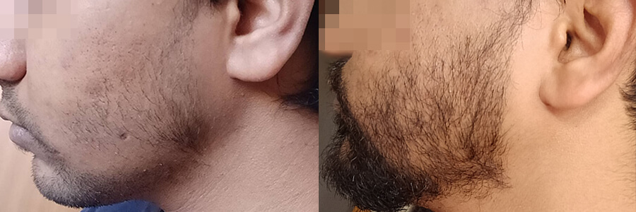 27 Year Old Indian Male Black Facial Hair Transplant Before/After Example -  Hair Restoration Centers