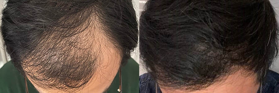 48 Year Old Asian Male Black FUE Hair Transplant Before/After Example