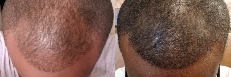 39 Year Old African Male Black FUE Hair Transplant Before/After Result