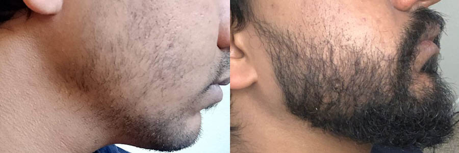 24 Year Old Indian Male Black Facial, FUE Hair Transplant Before/After Result