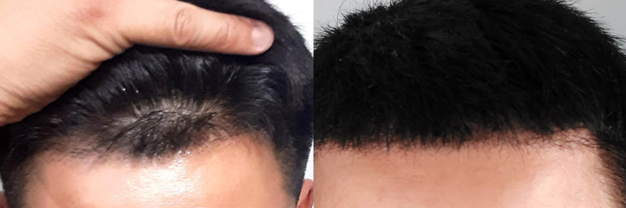 34 Year Old Asian Male Black FUT Hair Transplant Before/After Example