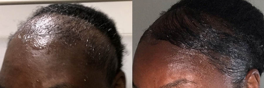 46 Year Old African Female Black FUT Hair Transplant Before/After Result