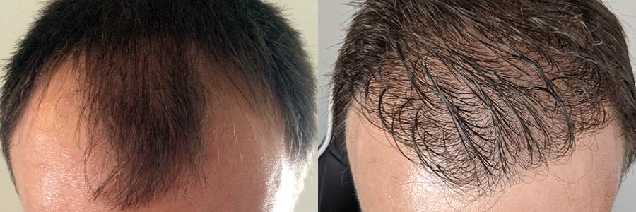 36 Year Old Caucasian Male Black FUE Hair Transplant Before/After Example -  Hair Restoration Centers