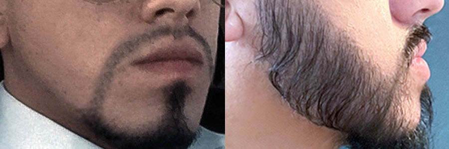 28 Year Old Caucasian Male Black Facial, FUE Hair Transplant Before/After Result