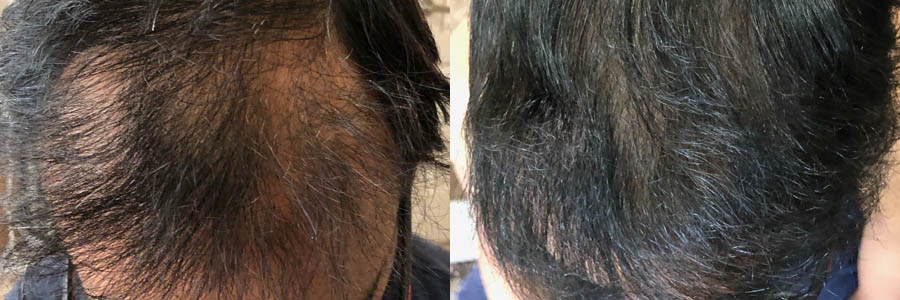 58 Year Old Asian Male Black FUE Hair Transplant Before/After Example