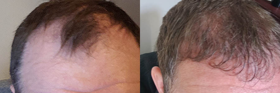 52 Year Old Caucasian Male Brown FUE Hair Transplant Before/After Result