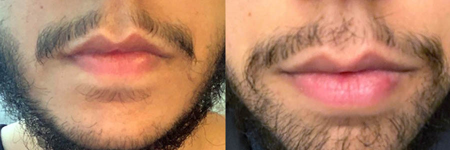 38 Year Old Indian Male Black FUE Facial Hair Transplant Before/After Result