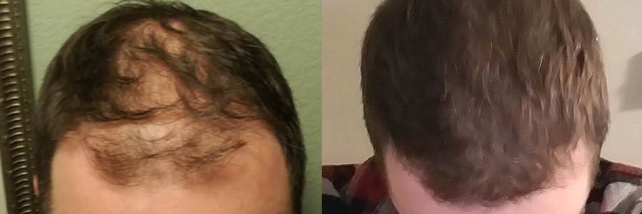 35 Year Old Caucasian Male Brown FUE Hair Transplant Before/After Result
