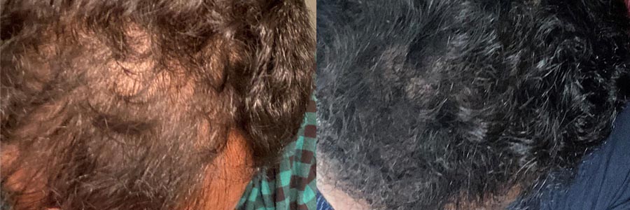 47 Year Old Caucasian Male Black FUE Hair Transplant Before/After Result