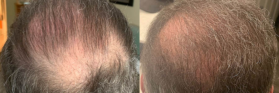 71 Year Old Caucasian Male Gray FUE Hair Transplant Before/After Result