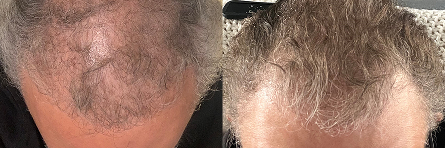 65 Year Old Caucasian Male Blonde FUE Hair Transplant Before/After Result