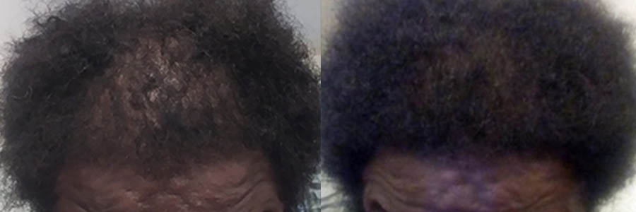 34 Year Old African American Male Black FUE Hair Transplant Before/After Result