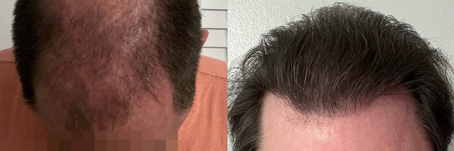 53 Year Old Caucasian Male Brown FUE Hair Transplant Before/After Result