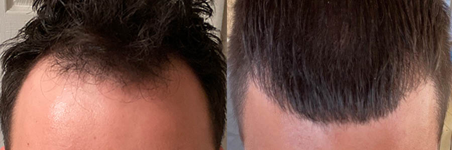27 Year Old Caucasian Male Black FUT Hair Transplant Before/After Result