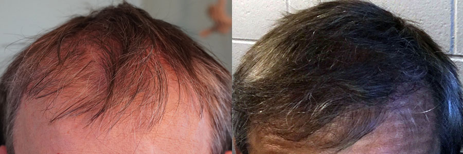 52 Year Old Caucasian Male Brown FUE Hair Transplant Before/After Result