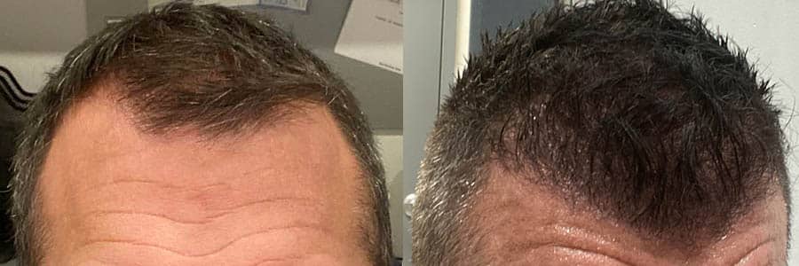 40 Year Old Caucasian Blonde FUE Hair Transplant Before/After Result