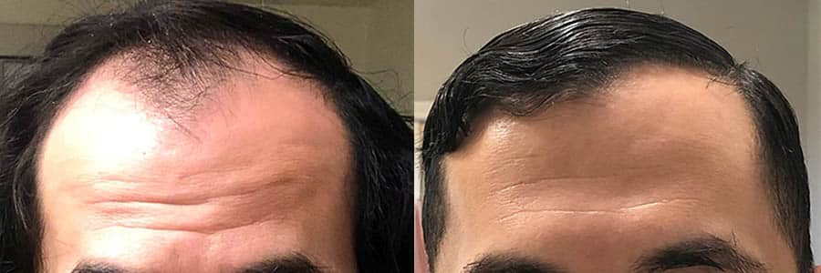 38 Year Old Caucasian Male Brown FUT Hair Transplant Before/After Result
