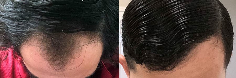 FUT Hair Transplant Before and After