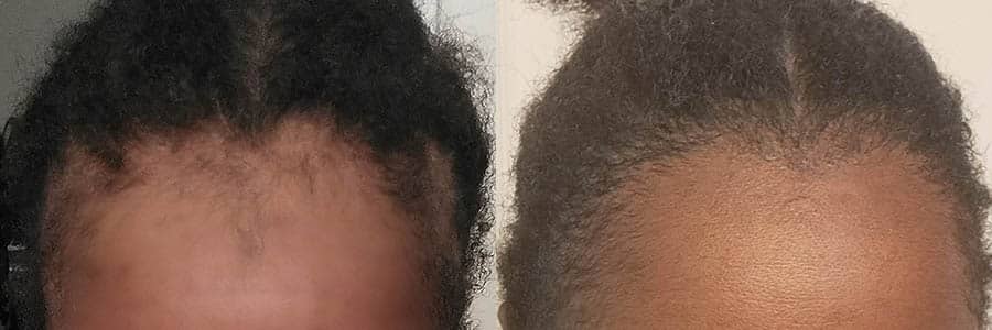 35 Year Old African American Female Black FUT Hair Transplant Before/After Result