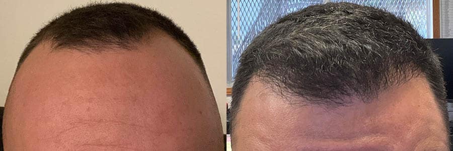 42 Year Old Caucasian Brown FUE Hair Transplant Before/After Result