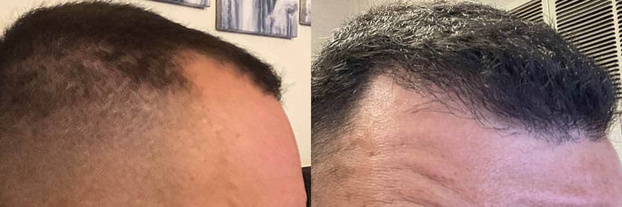 male 2000 fue grafts hairline