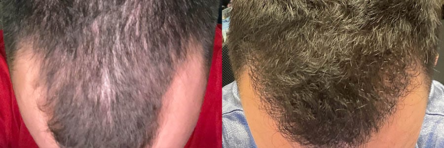 FUT Hair Transplant - Female Before and After
