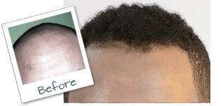 Chicago IL Hair Implants before and after