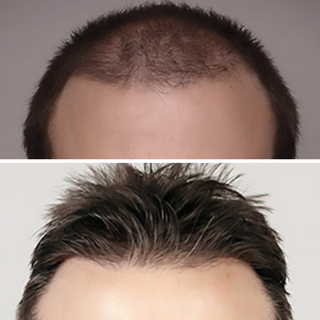 The Best Hair Transplants In Virginia Beach   HRC 4b Sq 