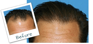 Miami FL Hair Plugs before and after