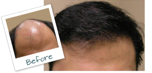 Rye Brook NY Hair Plugs before and after
