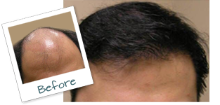 Virginia Beach VA Hair Restoration before and after