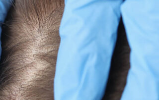 fue and fut hair transplant